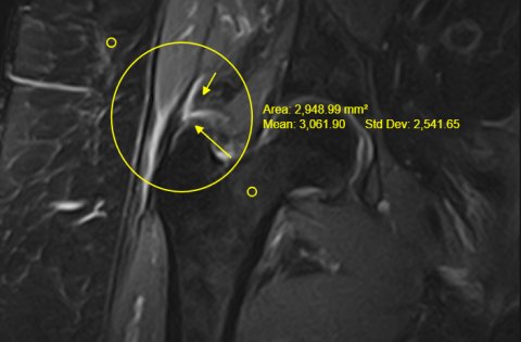 Rotura de tendons glutis en trocanteritis crònica